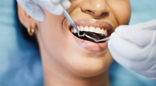 Best Emergency Dentist for Lost Fillings or Crowns in West Bradenton, FL